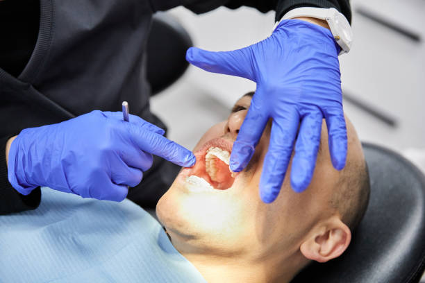 Best Emergency Wisdom Teeth Removal in Cut Off, LA