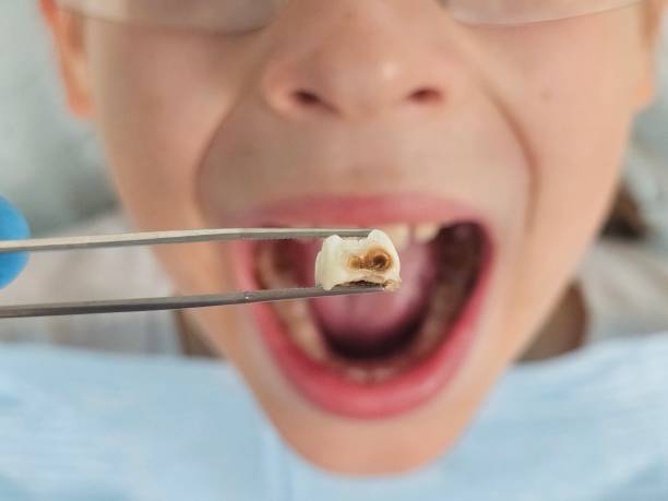 Best Emergency Tooth Extraction in Cut Off, LA